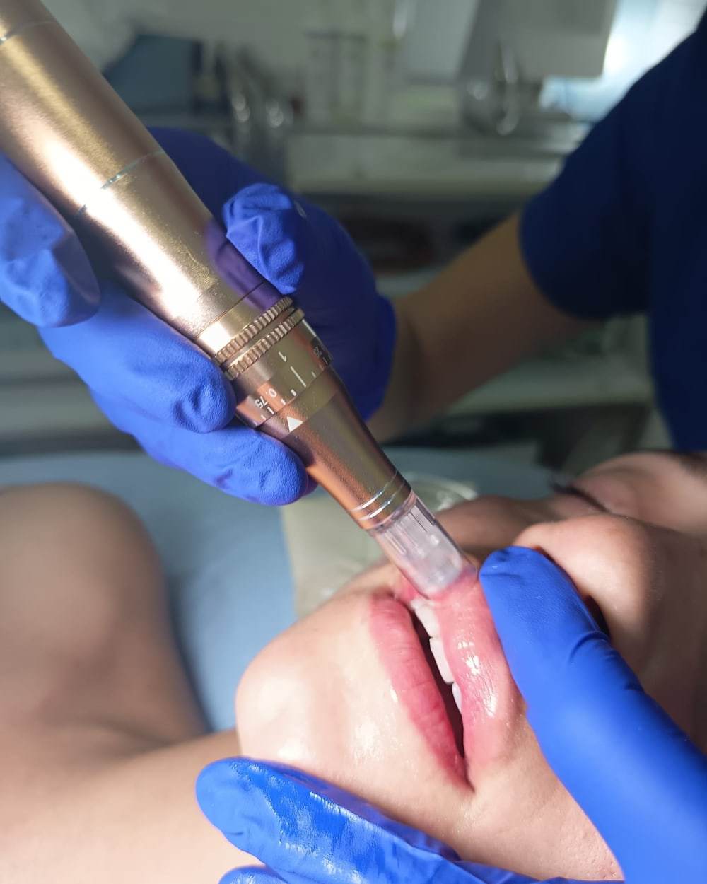 Tratamiento de labios en cabina en Medical Body